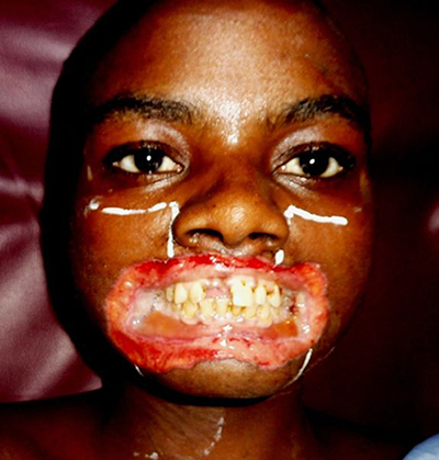 Intervention d'Interplast à Goma en 2015, blessure au visage