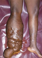 Elephantiasis